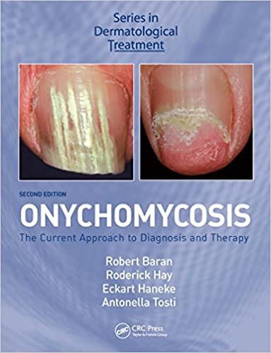 تحميل Onychomycosis: The Current Approach to Diagnosis and Therapy