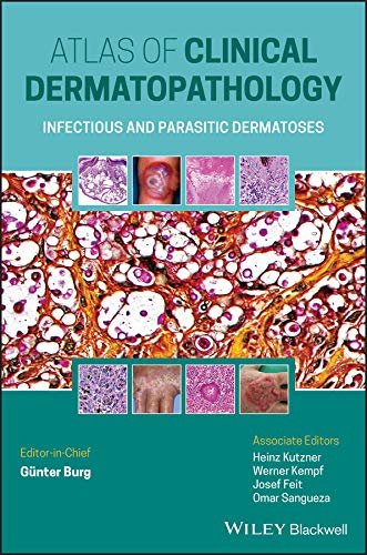 ダウンロード  Atlas of Clinical Dermatopathology: Infectious and Parasitic Dermatoses (English Edition) 本
