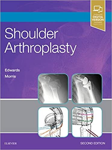 indir Shoulder Arthroplasty