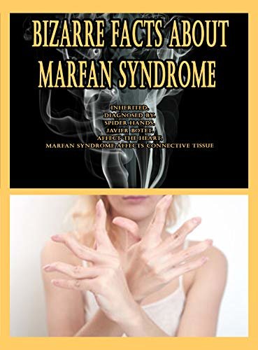 ダウンロード  Bizarre Facts About Marfan Syndrome: Inherited, Diagnosed By, Spider Hands, Javier Botet, Affect the Heart, Marfan Syndrome Affects Connective Tissue (English Edition) 本