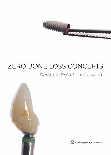 ダウンロード  Zero Bone Loss Concepts (English Edition) 本