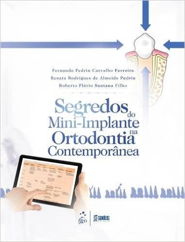 Segredos Do Mini-Implante Na Ortodontia Contemporanea