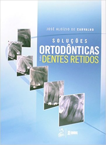 Solucoes Ortodonticas Para Dentes Retidos