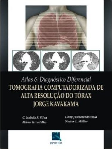 Tomografia Computadorizada De Alta Resolução Do Torax Jorge Kavakama. Atlas E Diagnostico