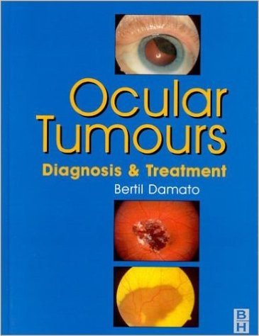 Ocular Tumours: Diagnoisis & Treatment