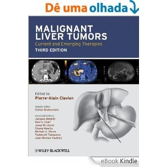 Malignant Liver Tumors: Current and Emerging Therapies [eBook Kindle] baixar