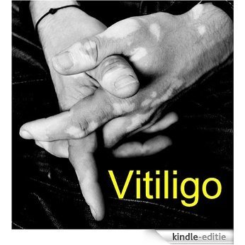 VITILIGO: Symptoms, Causes, Diagnosis and Effective Treatments - Official Guide from the National Institute of Skin Diseases (English Edition) [Kindle-editie]