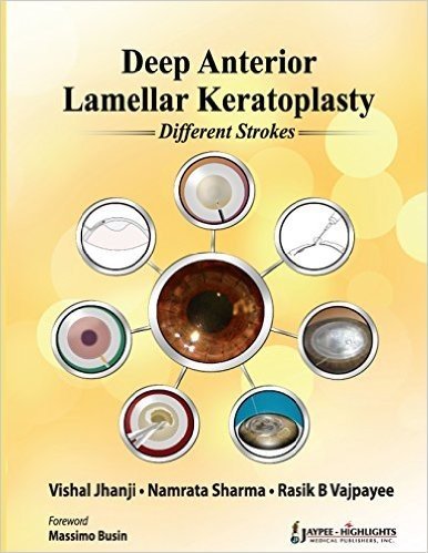Deep Anterior Lamellar Keratoplasty: Different Strokes