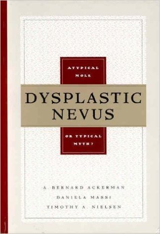 Dysplastic Nevus: Atypical Mole or Typical Myth?